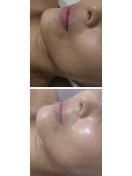 ミカ ネスト(Mika Nest)/肌質改善