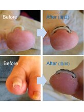 テネシー/巻き爪には2