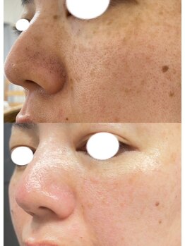 チュベルフェ(tu belle fe)/大人気！幹細胞はlitで