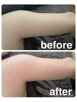 ギンザアール(GINZA R.)/挙式前の二の腕ケア！