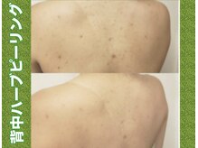 ブレア(Blair)/背中ピーリング