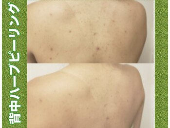 ブレア(Blair)/背中ピーリング