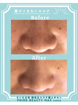マックス 与野店(MAX)/【毛穴の黒ずみ】だって◎