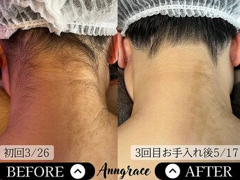 アングレイス(Anngrace)/【顔脱毛うなじ】Before/After