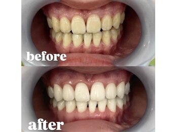 ホワイトラボ(WHIITE LAB.)/before→after