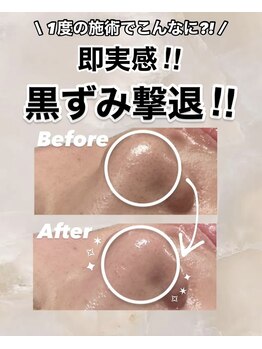 ビレボ マエバシ(BEREVO maebashi)/Before After