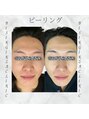 ビシンメディカルサロン(BISIN MEDICAL salon)&nbsp;毛穴/美白/ニキビ/たるみ/シワ/シミ/新宿/小顔/ピーリング/痩身