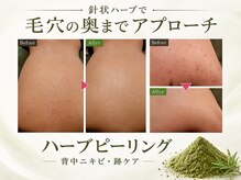 プライベートエステサロン トゥインクルの雰囲気（【針状ハーブピーリング】背中や顔のニキビ・跡ケア・毛穴改善◎）
