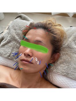 アキュリス(aquliss)/美顔鍼