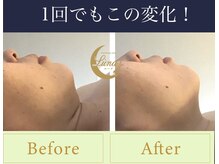 ルーナ(LUNA)/速効性あり！小顔リフトMAX！