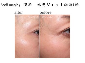 からだ庵 弘明寺本院/上清液+水光導入、しわ緩和/改善