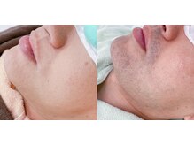 メグサロン(megu salon)/ヒゲ脱毛/敏感肌も美肌に！