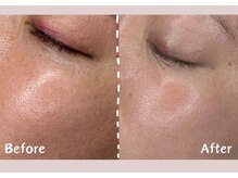 シー センター北(sii)/ララピールで叶える、均一な美肌