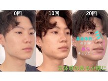 ラプリ 大宮店(Raplit)/隆鼻＋輪郭矯正40分30回