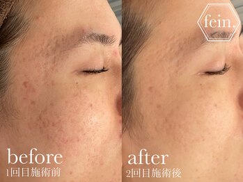 フェイン 青山店(fein.)/美白ケアに最適!