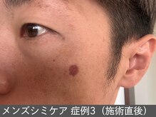 オアシスラグーン(OASIS LAGOON)/メンズシミケア（症例3 施術後）