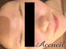 アクール(Accueil)/毛穴ケア/肌質改善/ニキビケア