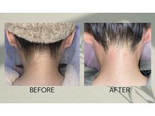 フリルスタイル(FRILL STYLE)/うなじダブル脱毛