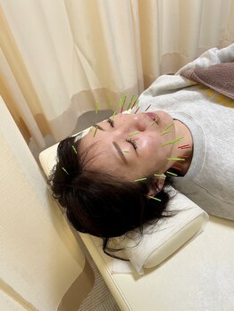 まごころ整骨院/大人気！美容鍼