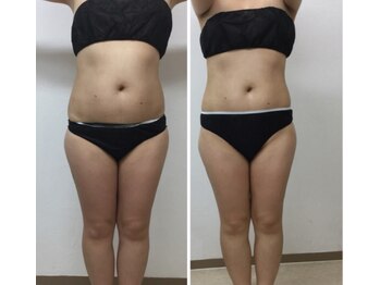 レミュー/ぽっこりお腹もメリハリくびれへ