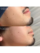 カナウ(KANAU)/ヒゲ脱毛（20代前半男性）