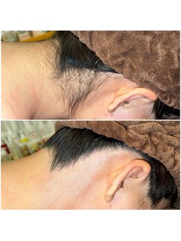 エースタイル(A-style.)/うなじ☆シュガーリング脱毛