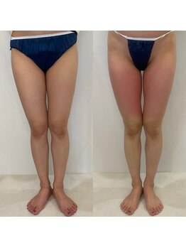 レミュ(Remu)/ビフォーアフター