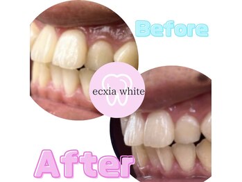 エクシアホワイトニング 八王子店/ホワイトニングビフォーアフター