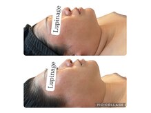 ルピナージュ(Lupinage)の雰囲気（【二重顎/フェイスラインスッキリ】ハリ再生フェイシャル1回）