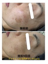 ソラリス(solaris)/シミケア