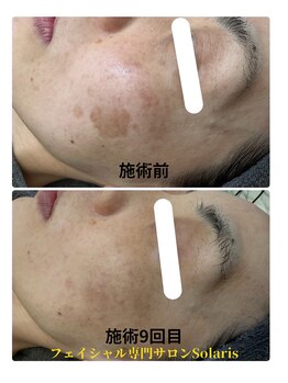 ソラリス(solaris)/シミケア