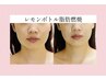 【フェイスラインキュッとすっきり小顔作り】レモンボトル2cc.2回30分