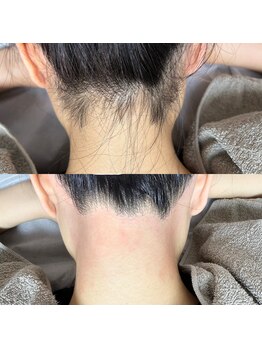 ルピナス(Lupinus)/うなじwax脱毛