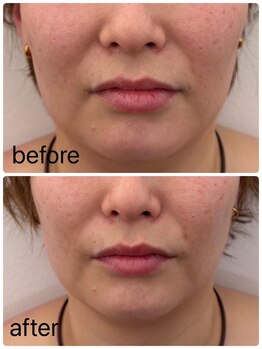 アズ(Azu)/RED SHOT