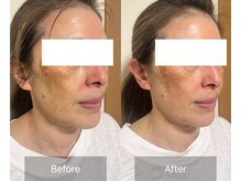 アファン 鶴見店(Afun)/小顔BeforeAfter