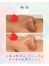 リリアン(lirien)/毛穴/毛穴ケア/毛穴洗浄/駒込