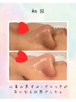 リリアン(lirien)/毛穴/毛穴ケア/毛穴洗浄/駒込