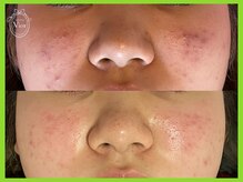 ヴィオール 名古屋栄店(VIOR)/ハーブピーリング