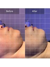 トータルエステサロン ポイント(POINT)/光フェイシャルでマイナス年齢肌