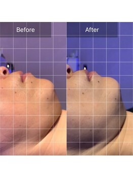 トータルエステサロン ポイント(POINT)/光フェイシャルでマイナス年齢肌