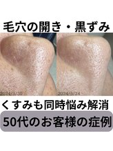 サロン イナンナ(Salon INANNA)/黒ずみ毛穴＆開き毛穴改善事例♪