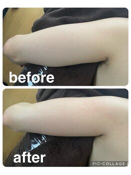 ギンザアール(GINZA R.)/二の腕集中！