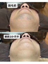 アカラ 読谷店(AKALA)/ひげ脱毛を継続して２か月経過