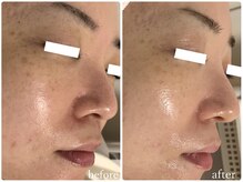 リリィブラン(Lily branc)/毛穴ニキビケアダブルピーリング