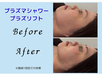 アール(R)/【 小顔ケア/プラズマリフト 】