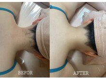 リス ブラン(Lys Blanc)/高評価☆えり足脱毛