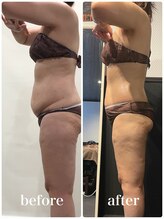 ピーラトゥ 日立(P-Ratu)/脂肪冷却◆