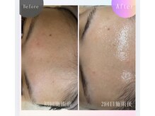 クリア 麻布十番(CLEAR)/XELHA PEEL セラピール