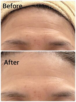 エルミナ.(elmina.)/おでこシワ改善　脂肪増殖５ml