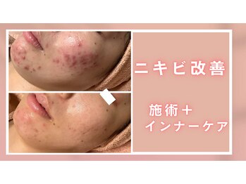 シャルナ(charna)/ニキビ改善